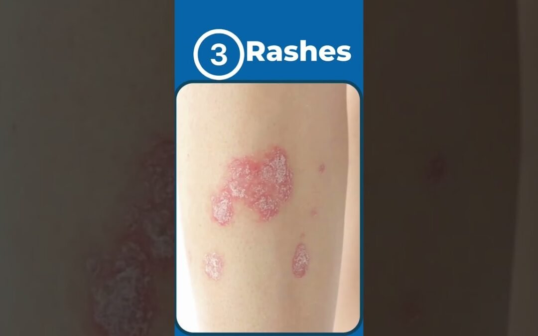 5 Signs of Autoimmune Disease #rheumatoidarthritis #lupus #psoriaticarthritis #autoimmunedisease