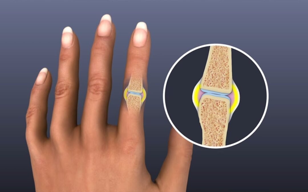 Mayo Clinic Minute: Fighting arthritis with food